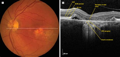 Atrophic lesion (A) revealing atrophy of the RPE and loss of normal... | Download Scientific Diagram