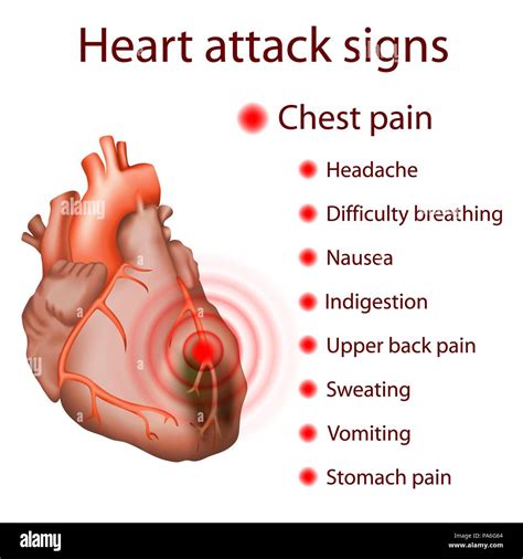 Heart attack (myocardial infarction) signs, illustration Stock Photo - Alamy