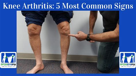 Knee Arthritis- 5 Most Common Signs You Have It! - YouTube