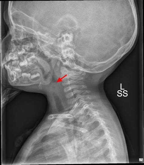 Epiglottitis - Causes, Symptoms, Diagnosis, Treatment