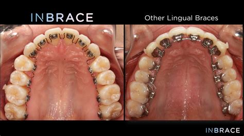 INBRACE™ Lingual Braces - Clarity Orthodontics