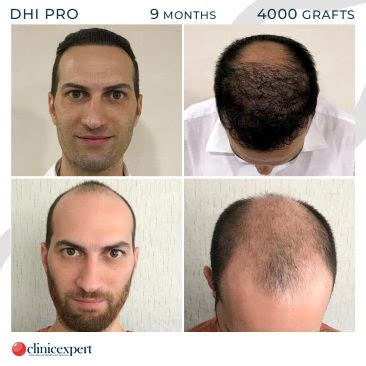 DHI Hair Transplant | ClinicExpert