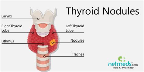 Nodules thyroïdiens: causes, symptômes et traitement