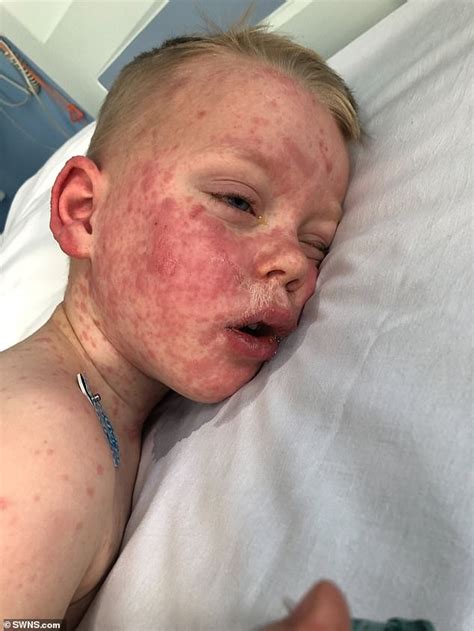 Schoolboy, five, was struck down by a rare disease which left him ...