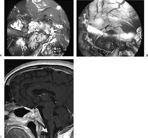 Intraoperative endoscopic view of the tuberculum sellae meningioma ...