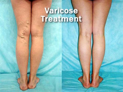 Varicose Veins Treatment - Keep Vitality