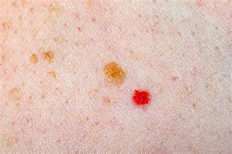 Nevus and Cherry Angioma on Human Skin Stock Photo - Image of color ...