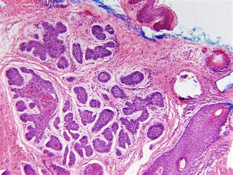 Acrochordon-like basal cell carcinomas in patients with basal cell nevus syndrome