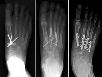 Lisfranc injury