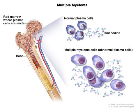 Bone Marrow Neoplasm - MyBioSource Learning Center