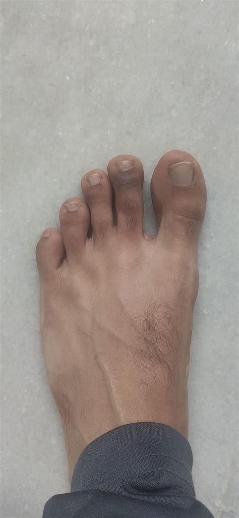 Why are toes turning dark? : skin