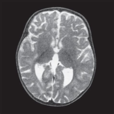 MRI of the brain. Disclosed global brain atrophy and delayed ...