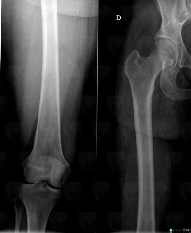 Radiology case : Enchondroma (X rays ,MRI) - Diagnologic