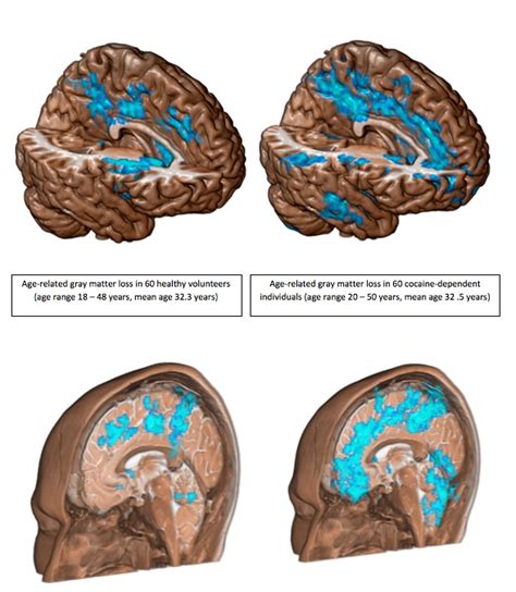 Cocaine Eats Up Brain Twice as Fast as Normal Aging | Live Science