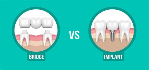 What is better Tooth Implant or Bridge | The Dental Clinic