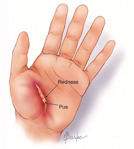 Wound Infections | Infectious Diseases | JAMA | JAMA Network