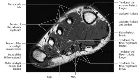 Mri Plantar Foot Anatomy Muscles