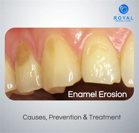 Royal Dental Clinic | ARTICLE?U=ENAMEL-EROSION-CAUSES-PREVENTION-AND-TREATMENT