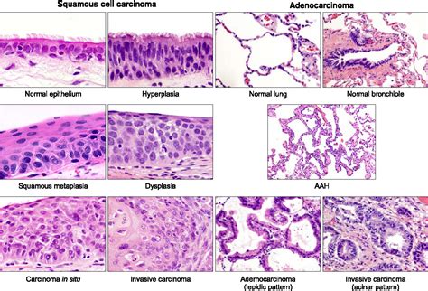 Adenocarcinoma Vs Squamous Cell | My XXX Hot Girl