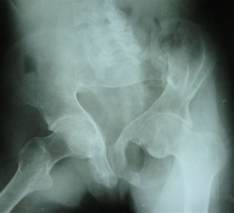 Osteomalacia Causes and Treatment | Bone and Spine