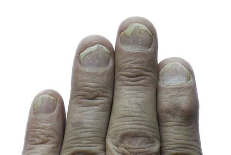 Nail Psoriasis: Causes, Symptoms, Diagnosis, Treatment