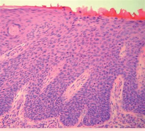 Erythroplasia Queyrat