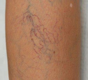 Types of Spider Veins and Formations | NYC