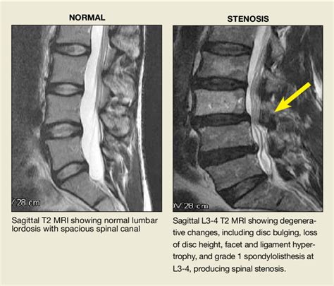 Lumbar Spine Mri Lumbar Spinal Stenosis Mri Spinal Stenosis Lumbar | My ...