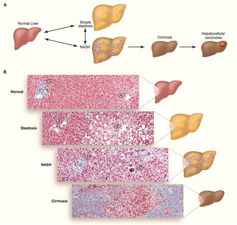 Human Fatty Liver Disease: Old Questions and New Insights | Science