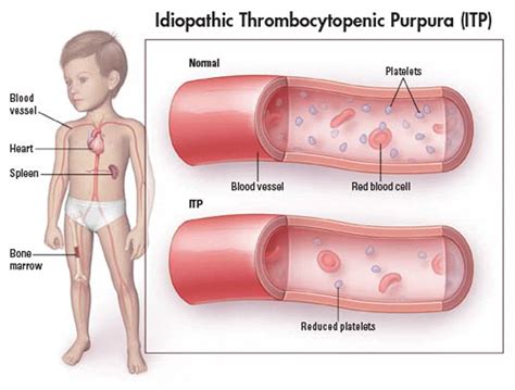 Idiopathic Thrombocytopenic Purpura Nursing Care Management - Nurseslabs