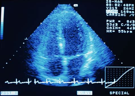 The "Bubble Study" for Patent Foramen Ovale