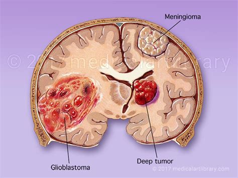 Brain Tumor, Glioblastoma, Meningioma - Medical Art Library