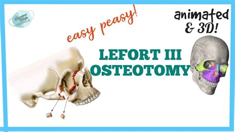 LEFORT III OSTEOTOMY || MAXILLARY OSTEOTOMY - YouTube