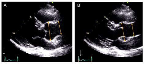 JCM | Free Full-Text | Are Aortic Root and Ascending Aorta Diameters ...