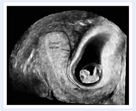 Figure 1 from The pregnancy outcome in women with incidental diagnosis of septate uterus at ...