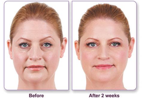 Juvederm May Help Correct Your Nasolabial Folds Without Surgery ...