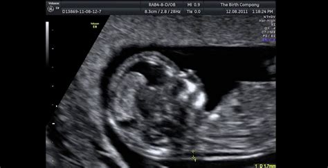 down syndrome baby at 14 weeks ultrasound - Unlimited Blogged Custom ...