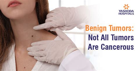 Benign Tumours-Not All Tumours Are Cancerous|Yashoda Hospitals