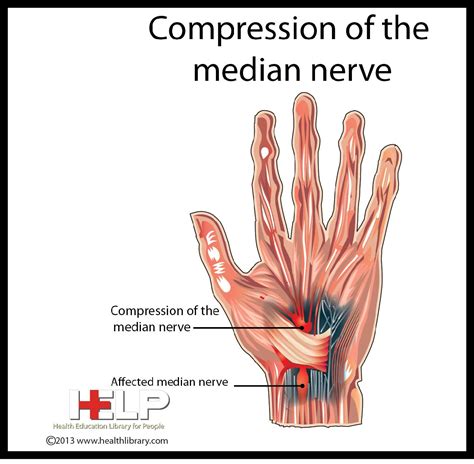 Compression of Median Nerve