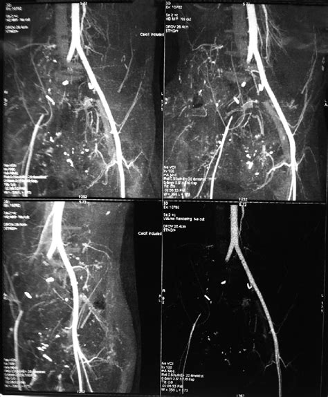 CT angiography showing thrombosis of right common iliac artery and... | Download Scientific Diagram