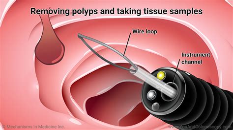 Slide Show - What happens during and after a colonoscopy?