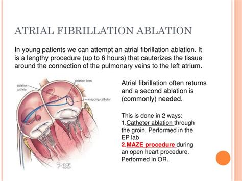 Catheter ablation for atrial fibrillation success rate