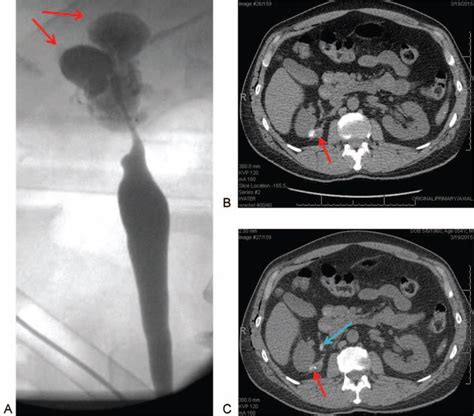 A) Intraoperative retrograde pyelography of right-sided collecting... | Download Scientific Diagram