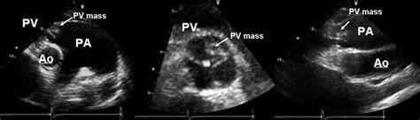 Transthoracic echocardiography at the level of the pulmonary valve ...