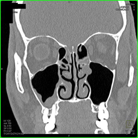 Right Maxillary Sinusitis with Normal Anatomy of the Head and Neck Region - Neuro Case Studies ...