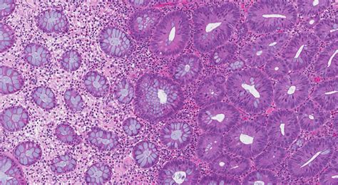 Tubular Adenoma Histology