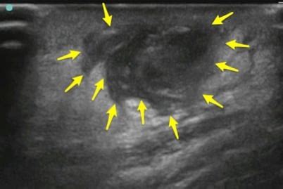 Abscess Ultrasound | ALiEM