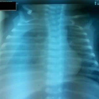 The chylous pleural fluid: "milk-like" appearance after pleural... | Download Scientific Diagram