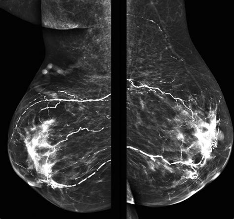 The role of mammography in calcific uremic arteriolopathy - Kidney International