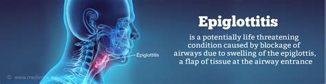 Epiglottitis - Causes, Signs and Symptoms, Diagnosis, Treatment & Prevention